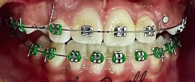 Dientes con brackets y ligaduras verdes