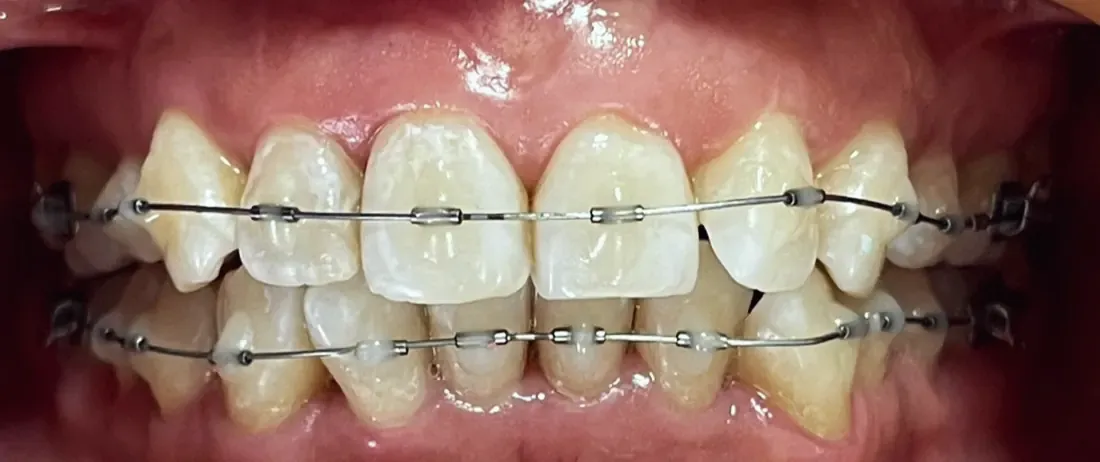 Arcadas con brackets metálicos