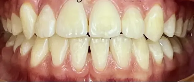 Los mismos dientes alineados después de retirar los brackets