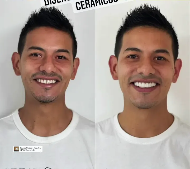 Antes y después de un diseño de sonrisa con lentes cerámicos
