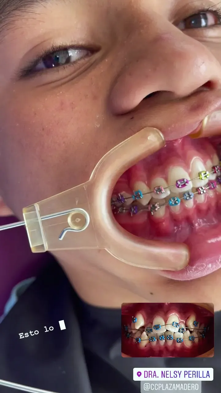 Paciente joven con brackets de colores